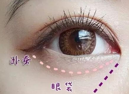 激光消除眼袋怎么樣？激光溶脂去眼袋多少錢？