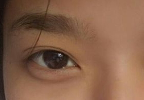 激光去眼袋后需多久能恢復(fù)？激光去眼袋快速有效嗎？