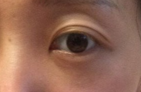 激光去眼袋要注意什么？