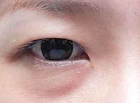 激光去眼袋的方法效果好嗎？激光去眼袋有什么壞處？