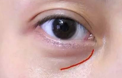 激光去眼袋手術費用是多少？