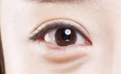 激光能祛除眼袋嗎？激光去眼袋有害處嗎？