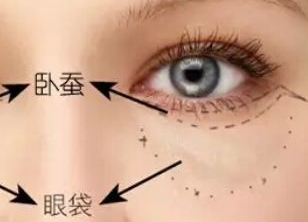 激光去眼袋多久才能恢復(fù)？激光去眼袋有什么副作用嗎？