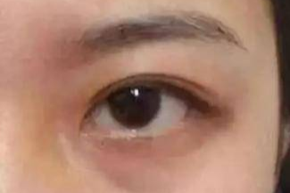 激光祛眼袋效果真的好嗎？激光去眼袋會有風(fēng)險嗎？