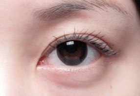 激光去眼袋會(huì)不會(huì)很疼？激光去眼袋什么人適合？