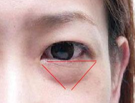 激光除眼袋效果如何？激光去眼袋要注意什么？