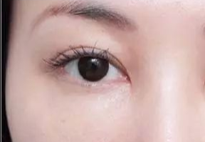 激光去眼袋什么人適合？