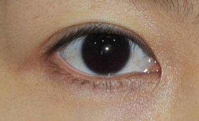 遵義韓美整形醫(yī)院開眼角怎么樣？開眼角的價格是多少？