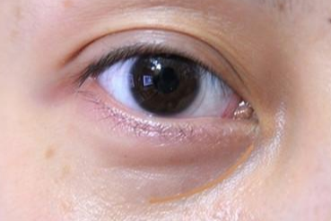 激光去眼袋多長時間能消腫？激光去眼袋能維持幾年？