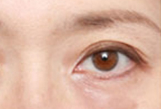 激光去眼袋幾天能恢復(fù)？激光去眼袋是怎樣的？