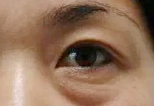 激光去眼袋會反彈嗎？