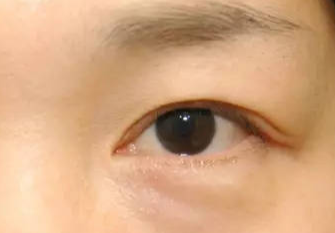 激光去眼袋術(shù)后會(huì)不會(huì)反彈？