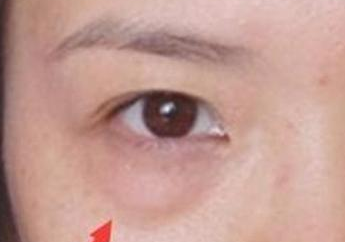 激光去眼袋的效果怎么樣？激光去眼袋注意事項(xiàng)有哪些？