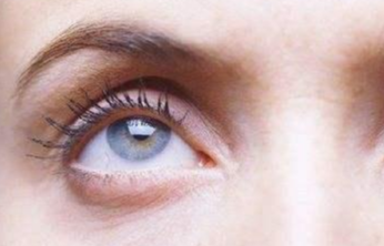 激光去眼袋幾天能消腫？