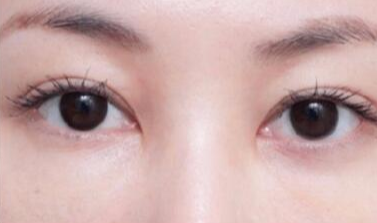 激光去眼袋術(shù)后注意事項(xiàng)有哪些？