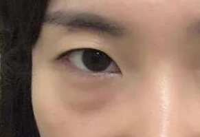 激光去眼袋有什么危害？激光去眼袋幾天能消腫？