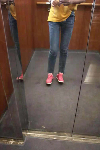 大腿環(huán)吸術(shù)術(shù)后成型效果