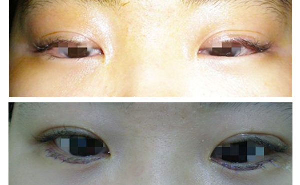 眼瞼內翻什么意思？眼瞼內翻怎么辦？