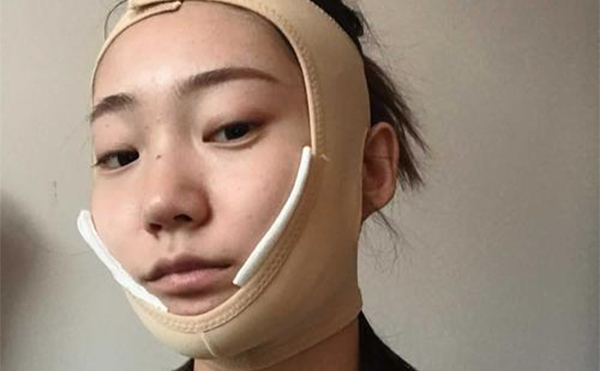 下頜角形術(shù)后注意事項(xiàng)