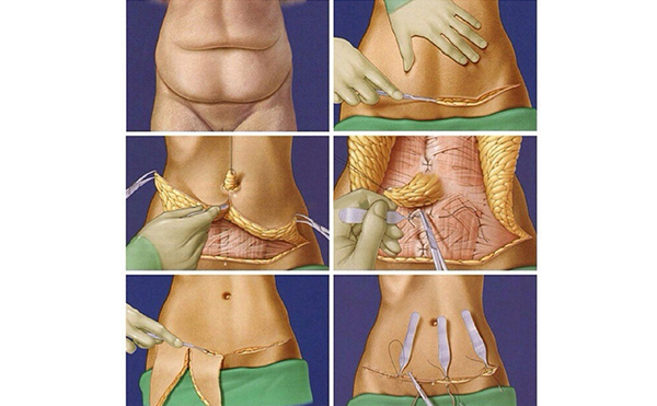什么是腹壁成形術(shù)?手術(shù)過(guò)程是什么?
