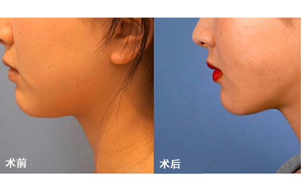 面部吸脂后皮膚會(huì)不會(huì)松弛？