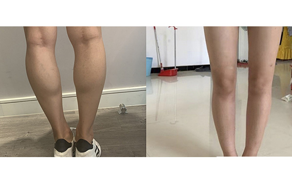 瘦腿針和吸脂哪個好？