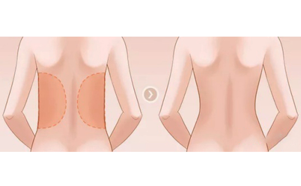 背部吸脂手術的關鍵在哪個部位？