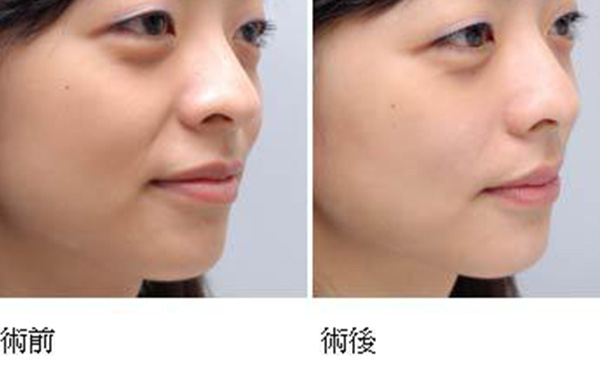 玻尿酸去法令紋需要多久能恢復(fù)？