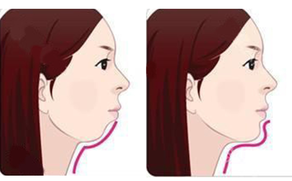 注射墊下巴的方式好嗎？