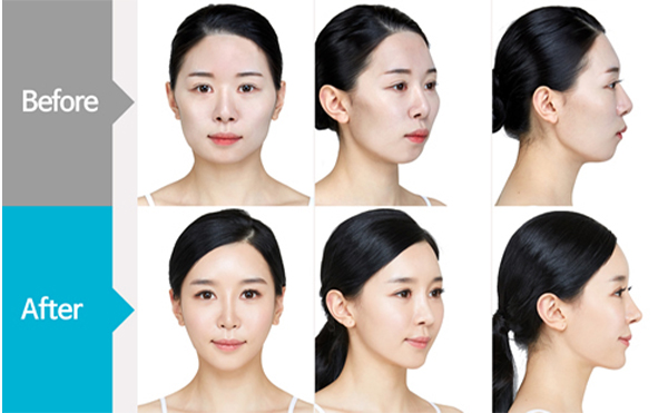 改臉型手術哪家好？