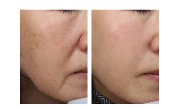 彩光嫩膚適合哪些人？