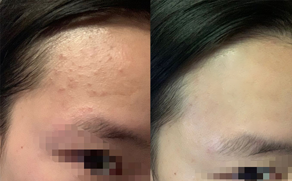 果酸煥膚后皮膚會(huì)變薄嗎？