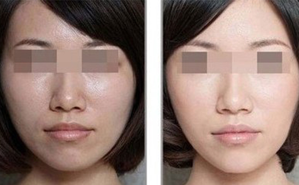 美白針的效果怎么樣？