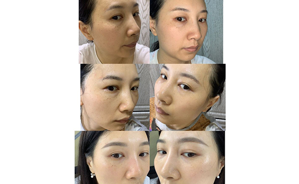 激光祛斑安全嗎？