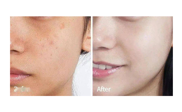 冰點嫩膚的效果怎么樣?有哪些優(yōu)點?