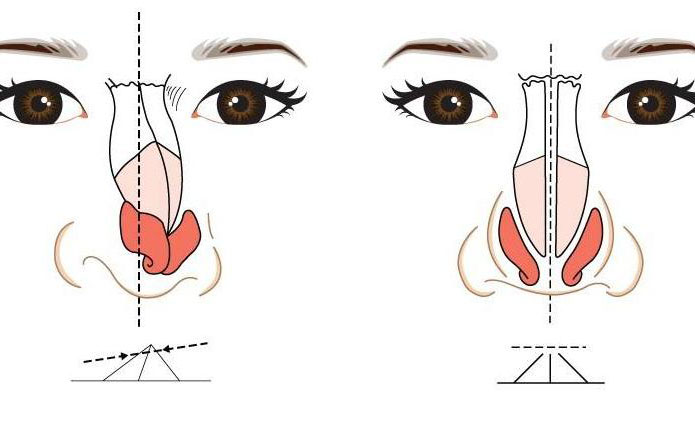 鼻子歪矯正大約多少錢？鼻子歪矯正恢復(fù)期多久？