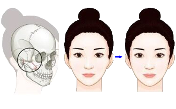 顴骨降低整形手術(shù)是怎么操作的？有什么特點？