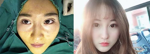 雙眼皮修復(fù)效果對(duì)比圖1