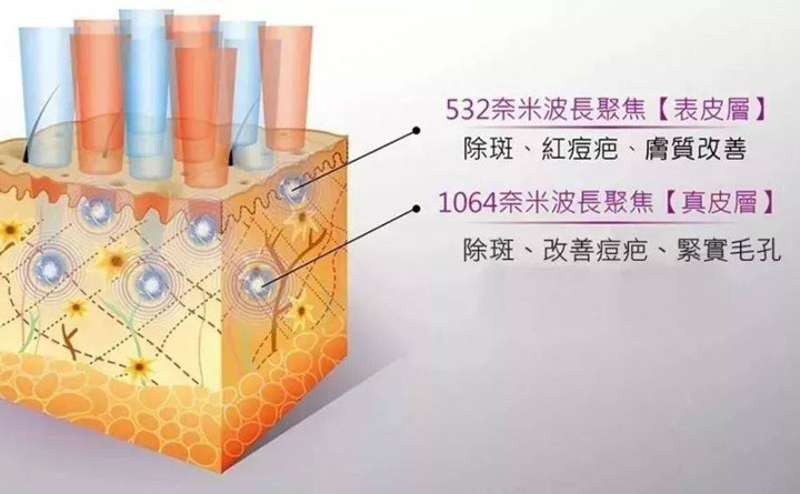 皮秒祛斑恢復(fù)期多久？