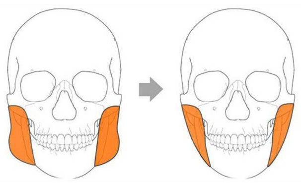 咬肌太大怎么辦？