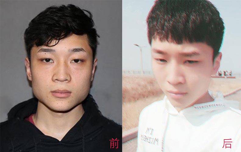 瘦臉針、面部吸脂如何選擇？