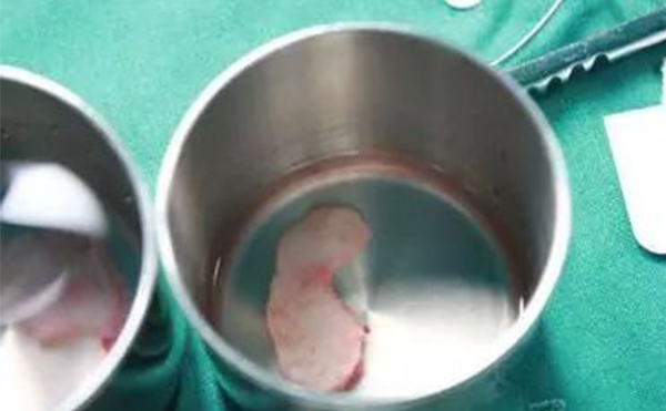 自體軟骨隆鼻是取自身體的那個部位？哪個部位的軟骨隆鼻效果更好