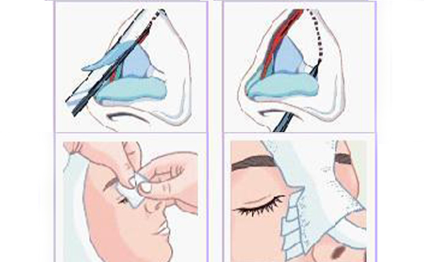 鼻小柱延長(zhǎng)手術(shù)材料有哪些？這些材料有什么優(yōu)勢(shì)
