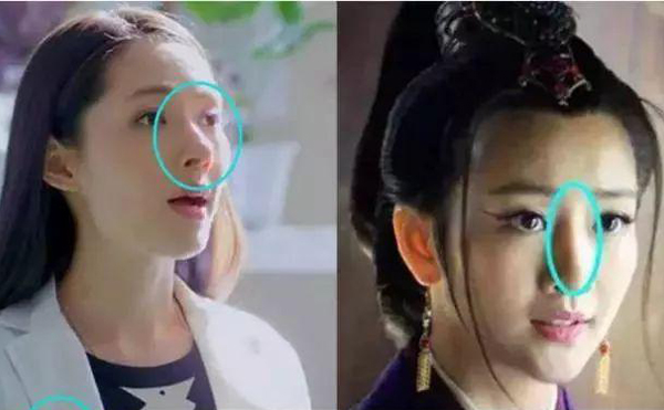 假體隆鼻安全嗎?假體會不會發(fā)生移動?