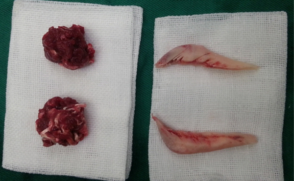 下頜角整形切除部分咬肌的原因