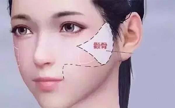 顴骨整形術(shù)后基本的護(hù)理措施有哪些?