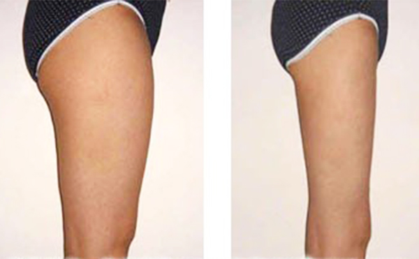 大腿吸脂會損壞肌肉嗎？