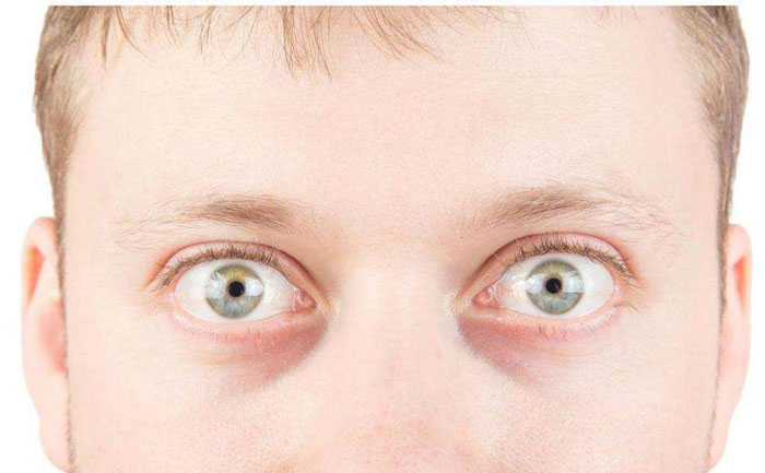 眼球突出是什么原因引起的？眼球突出如何矯正？