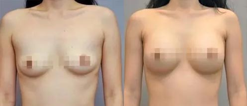 假體隆胸手術(shù)效果對(duì)比圖2