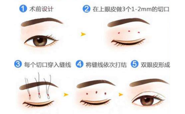 微創(chuàng)雙眼皮怎么做出來(lái)?微創(chuàng)雙眼皮幾天消腫?